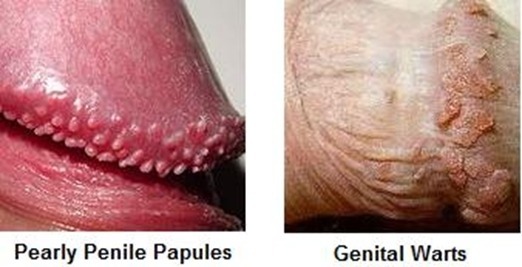 Pearly penile papules - Huidarts.com