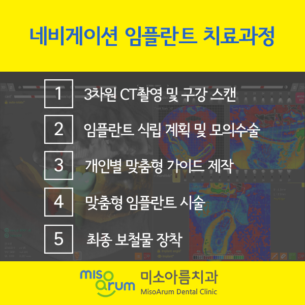 전주임플란트치과 빠진 치아를 방치할 경우 나타나는 문제점